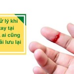 Cách xử lý khi bị đứt tay tại nhà mà ai cũng cần phải lưu lại