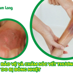 Cách bảo vệ và chăm sóc vết thương ở tay do bị bỏng nhiệt