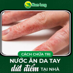Cách chữa nước ăn da tay dứt điểm tại nhà