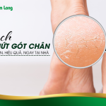 Cách trị nứt gót chân hiệu quả tại nhà bằng nguyên liệu tự nhiên