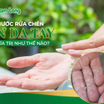 Nước rửa chén ăn da tay, chữa trị như thế nào?