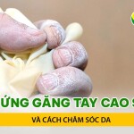 Dị ứng găng tay cao su và cách chăm sóc da