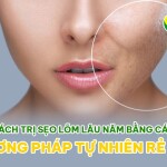 Cách trị sẹo lõm lâu năm bằng các phương pháp tự nhiên rẻ tiền