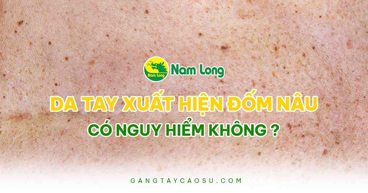 da tay xuất hiện đốm nâu như thế nào