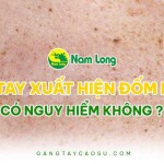 Da tay xuất hiện đốm nâu có nguy hiểm không?