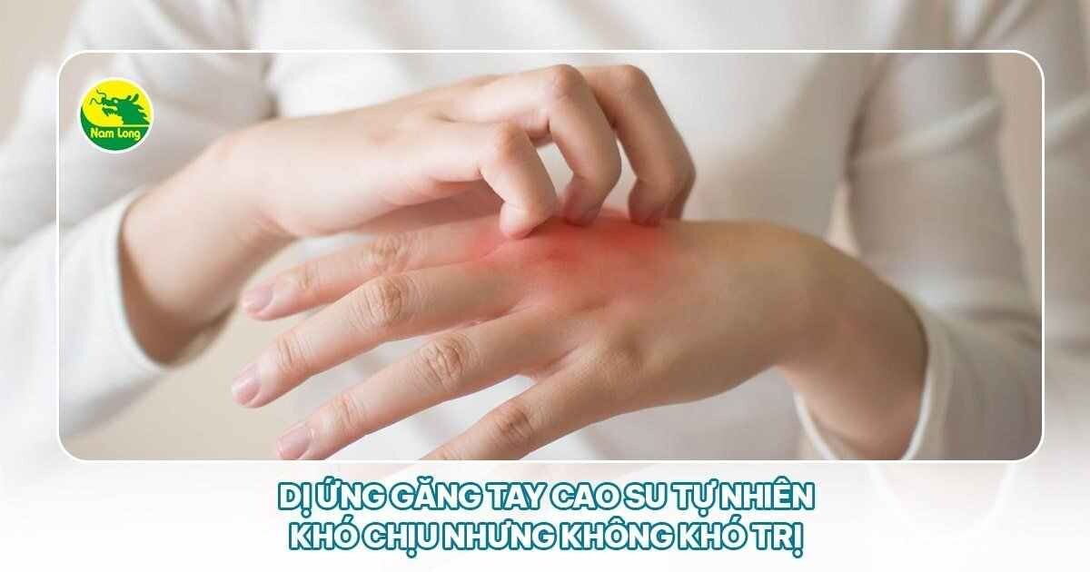 dị ứng găng tay cao su tự nhiên Nam Long