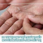 Da tay bị bong tróc không hiểu nguyên nhân khó lòng điều trị